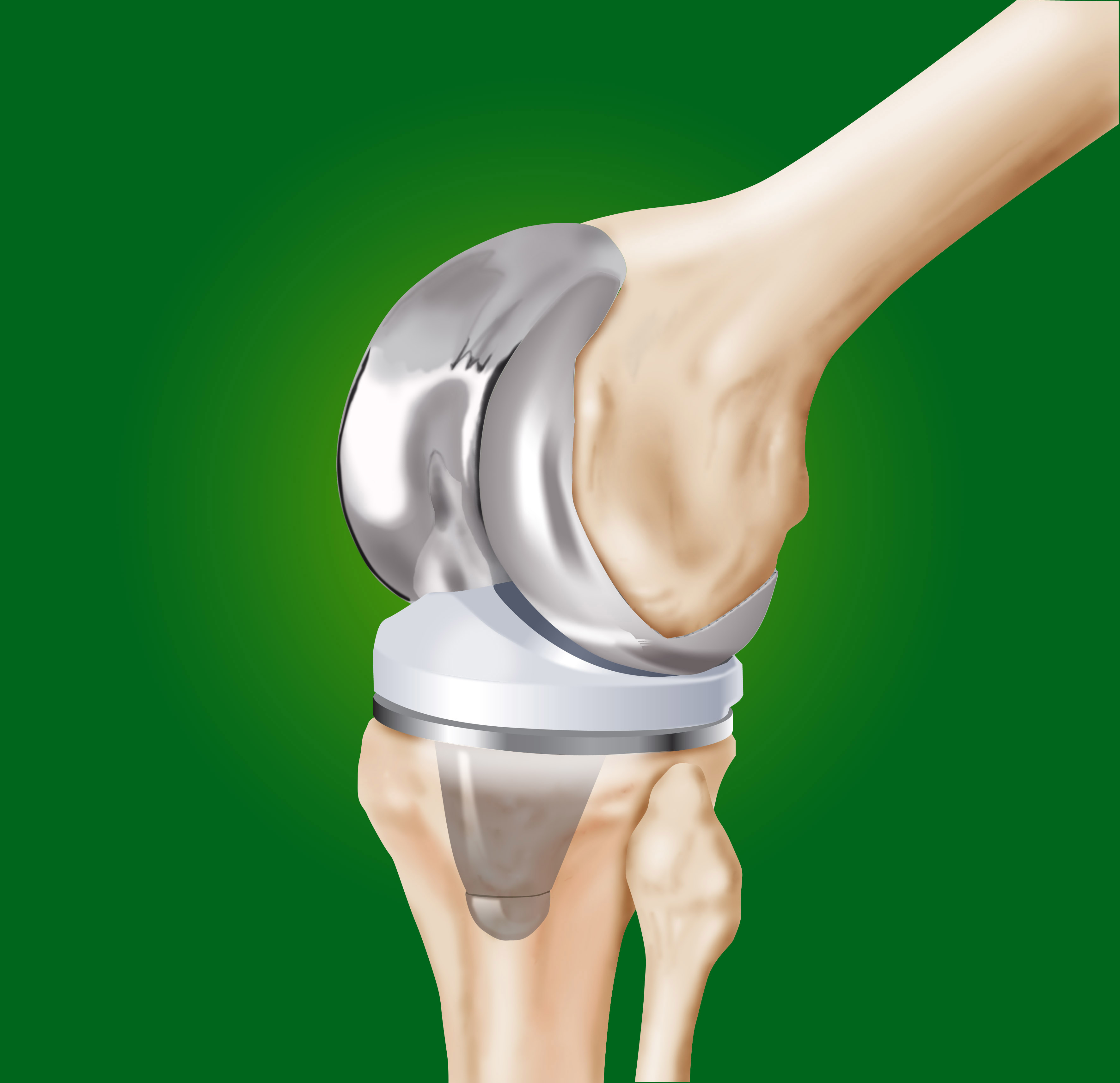 Операции на коленном суставе стоимость. Эндопротезирование коленного сустава. Эндопротез Aesculap Columbus. Эндопротез Зиммер коленного сустава е3. Эндопротезирования эндопротезирование коленного сустава.