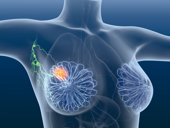 Cancer Sein GHEF Seine-et-Marne