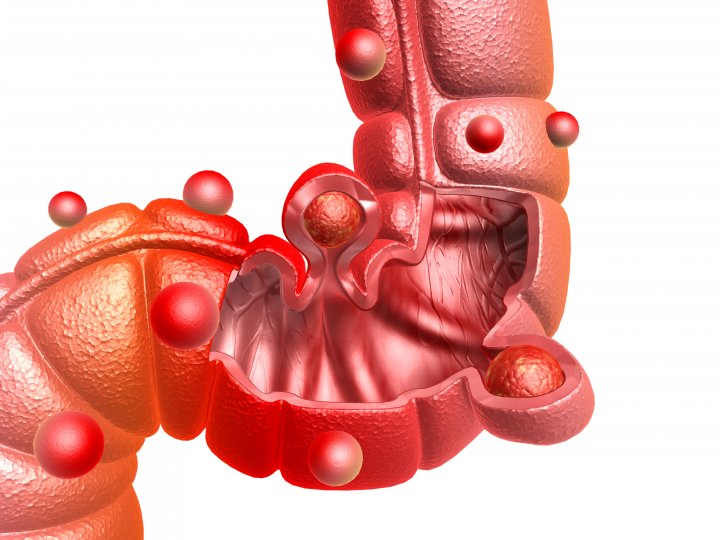 diverticulose colique GHEF gastroenterologie